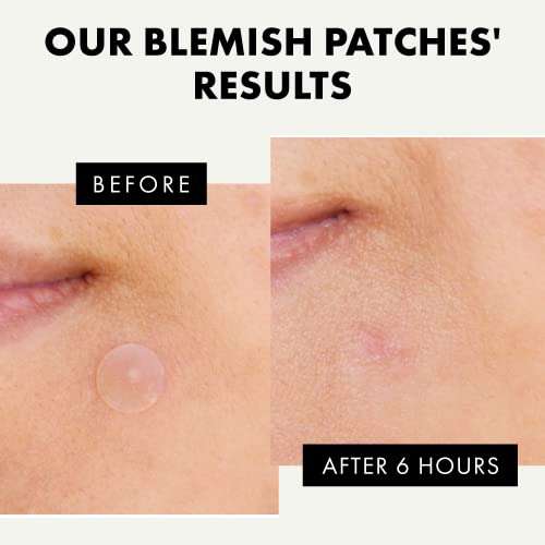 Pimple Patches for Face, Hydrocolloid Acne Patch 72 pieces - Eclat Skincare - 1 Dermatologist Developed FBA